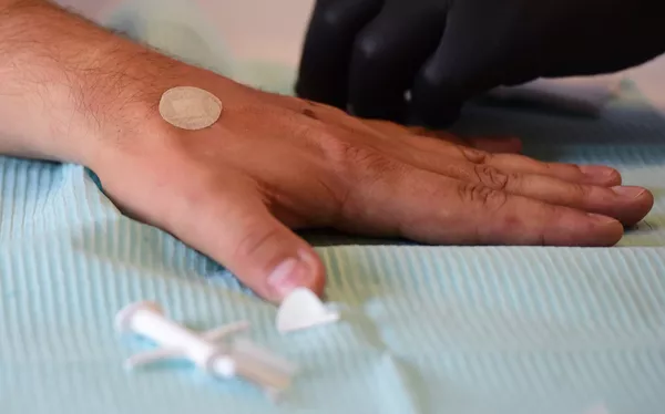 Место имплантации микрочипа на руке