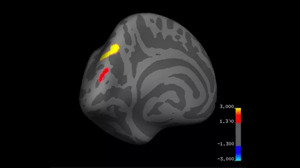 Изменения толщины всего мозга до и после кортикального слоя