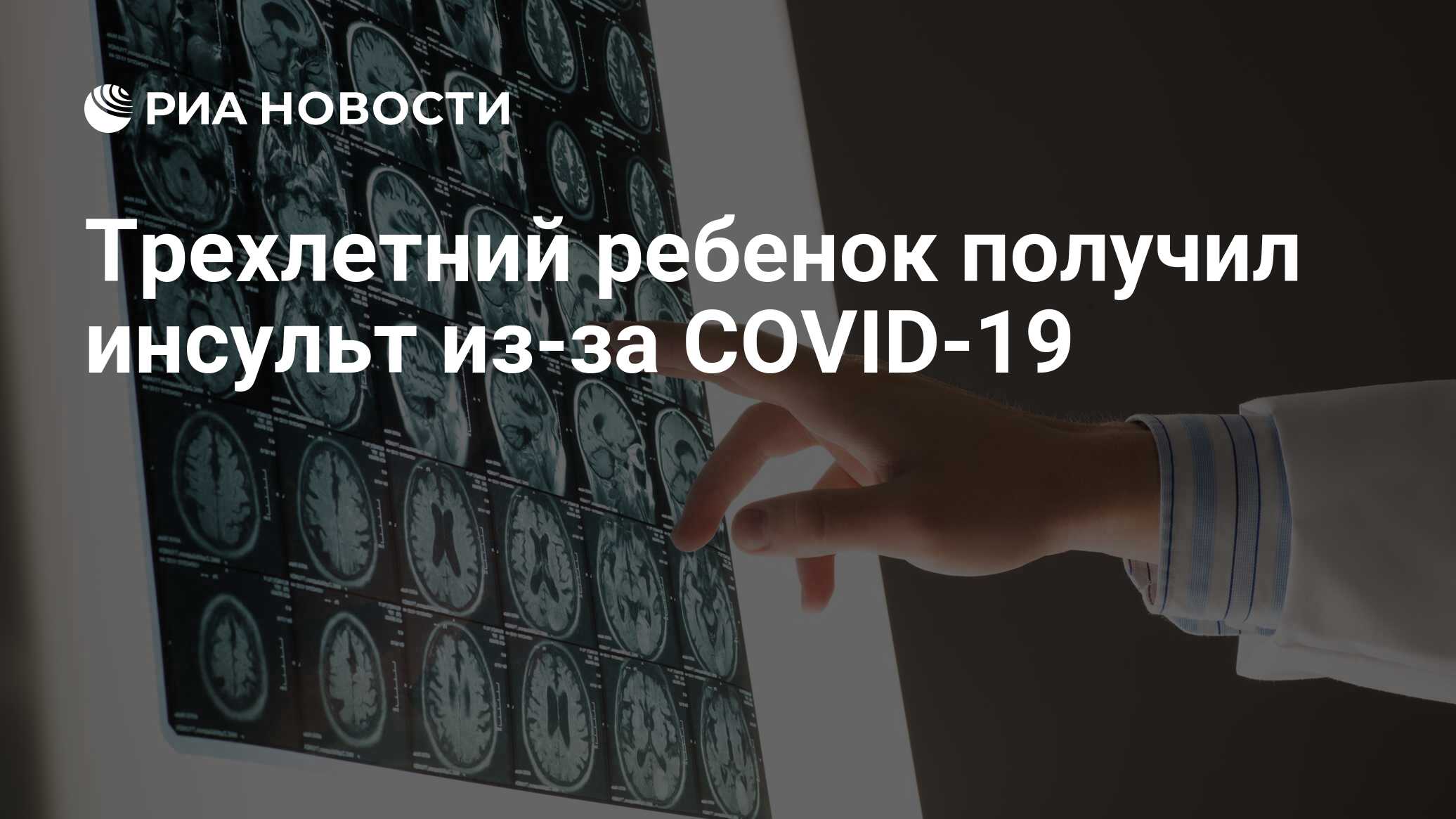 Трехлетний ребенок получил инсульт через COVID-19